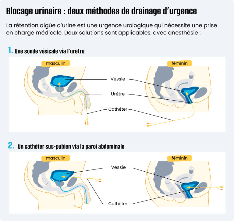 Infographie soigner une rétention urinaire