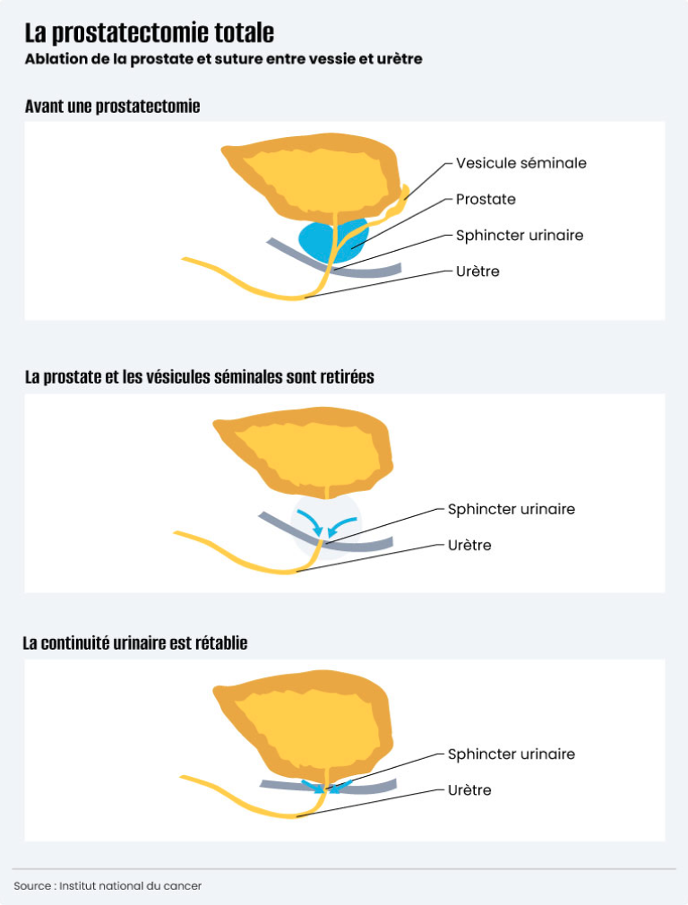 Infographie prostatectomie
