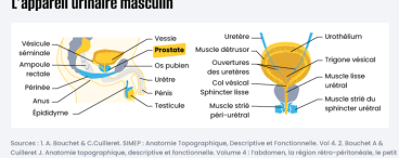 Adénome de la prostate