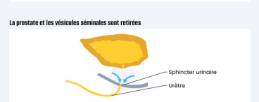 Infographie prostatectomie