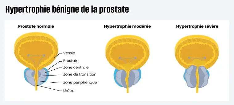 Visuel Prostate qui appuie sur la vessie